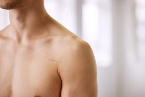 dry needling bij frozen shoulder