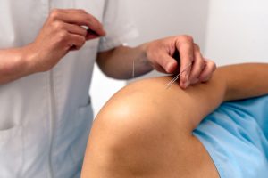 helpt dry needling bij frozen shoulder