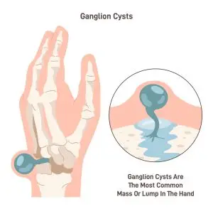 wat is een ganglion