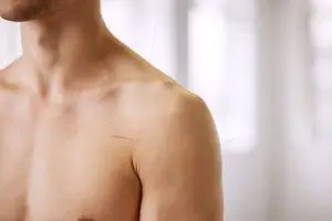 dry needling bij frozen shoulder